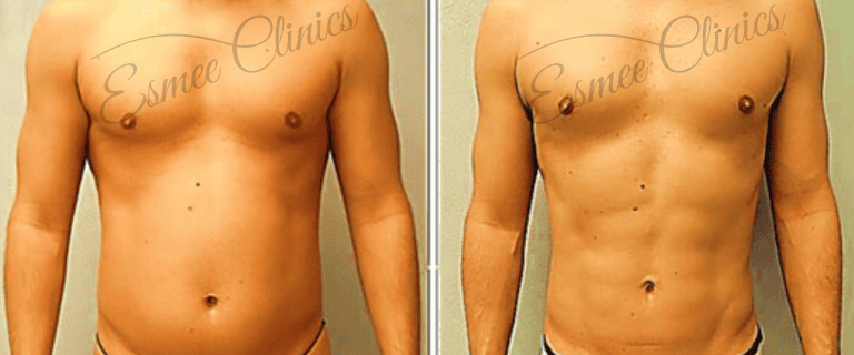 Before and After img